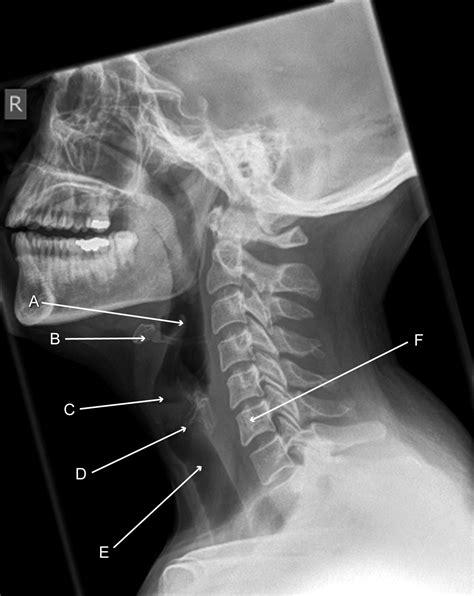 soft tissues of the neck x ray